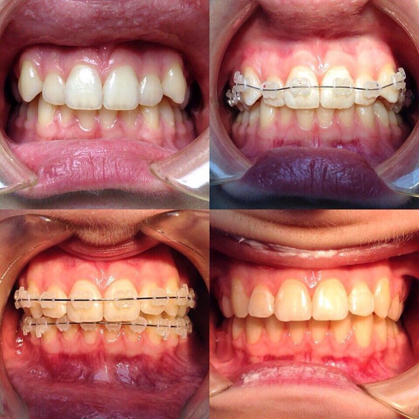 before-and-after-braces