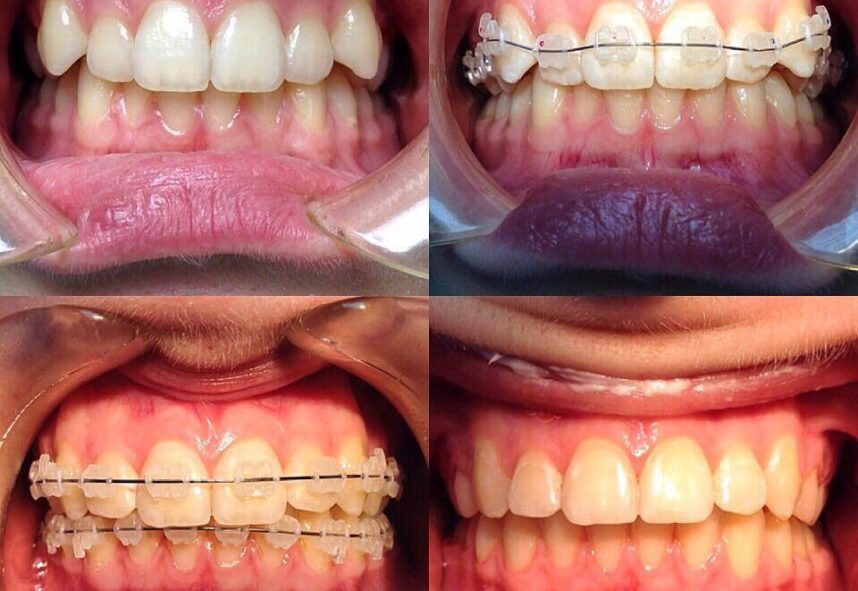 before-and-after-braces