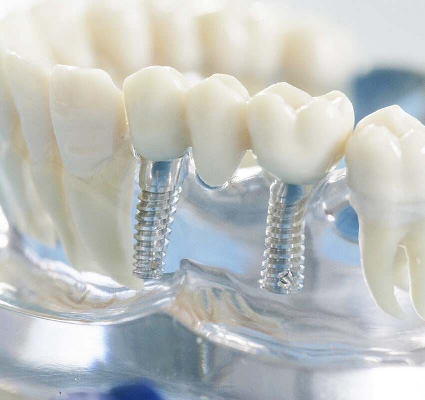 Steht eine Behandlung mit Zahnimplantaten an, so sollten Raucher etwa zwei bis drei Wochen vor dem OP-Termin sowie fünf bis sechs Wochen danach auf Zigaretten verzichten, da das Nikotin die Blutzirkulation hemmt und so die Wundheilung und die Einheilung der Implantate erschwert oder sogar verhindern kann. Studien haben gezeigt, dass Zahnimplantate bei Rauchern eine dreimal so hohe Komplikations- und Misserfolgsrate wie Nichtraucher aufweisen.



Die Verwendung dieses Bildes ist nur für redaktionelle Zwecke und ausschließlich in Bezug auf das Thema Zahnmedizin gestattet. Die Bearbeitung des Bildes ist nicht erlaubt, mit Ausnahme der Verkleinerung oder Vergrößerung sowie der technischen Aufbereitung zum Zweck der optimalen Vervielfältigung. Die Weitergabe dieses Bildes an Dritte und insbesondere der honorarpflichtige Vertrieb/die Speicherung in Bilddatenbanken ist untersagt. Der Abdruck ist ausschließlich unter Nennung der Quellenangabe: "proDente e.V." honorarfrei. 



Eine reprofähige jpg-Datei ist unter www.prodente.de im Pressezentrum abrufbar.



Erzeugt mit Caption Writer II.