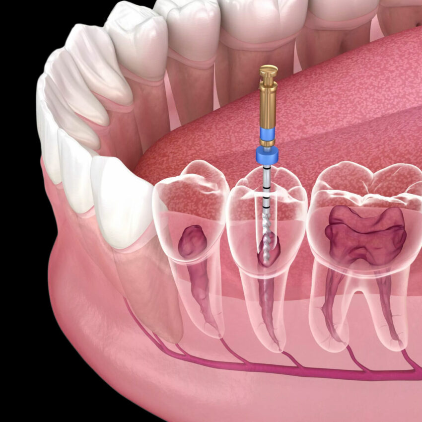 root-canal